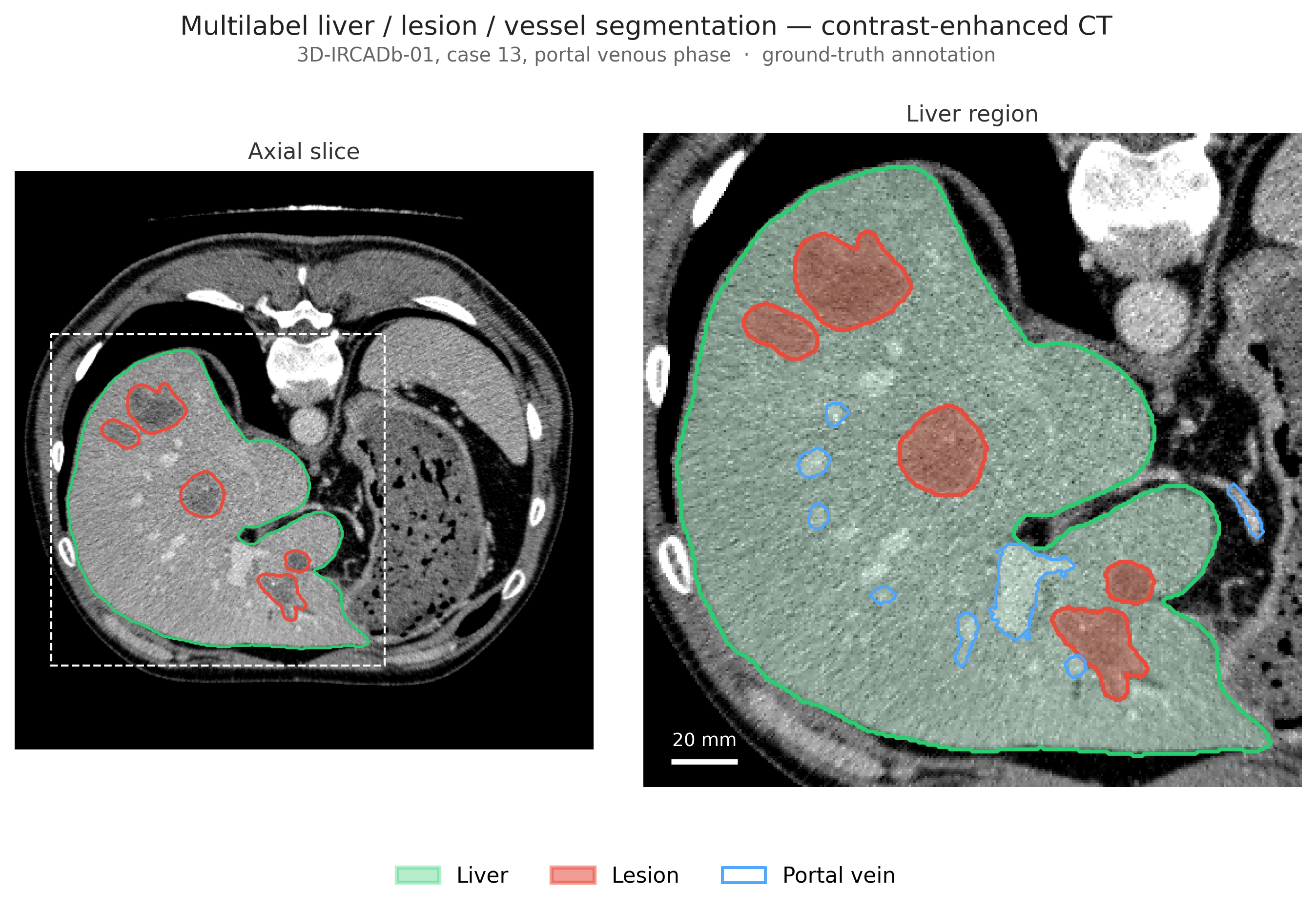 Axial contrast-enhanced CT slice with liver, lesion and portal-vein labels outlined, beside a magnified view of the liver region.